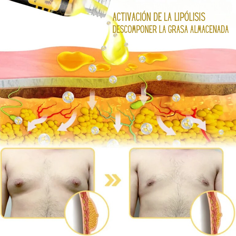 Bee venom Gynecomastia Heating Oil 15 ml (BUY 1 GET 1 FREE)